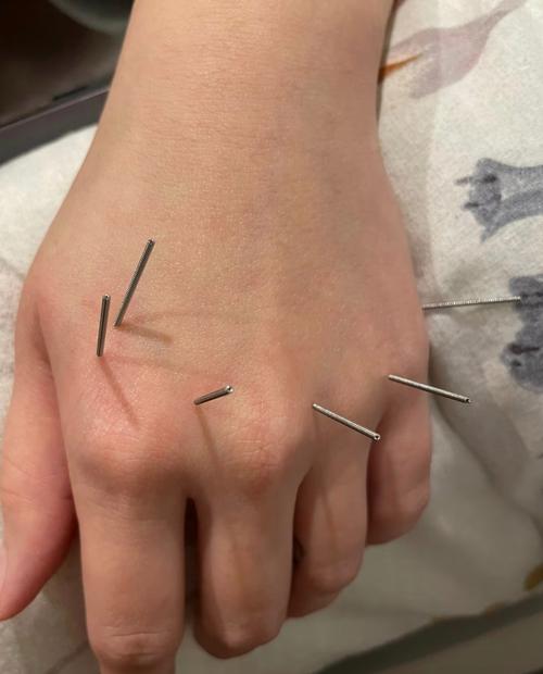 中暑针灸的治疗方法