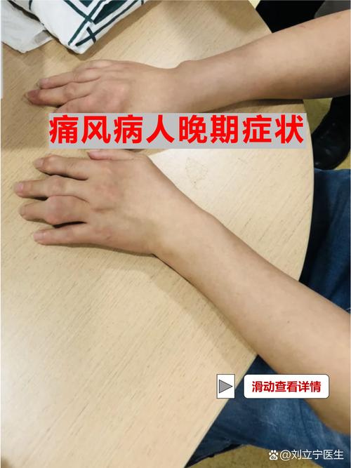 痛风生孩子有什么影响