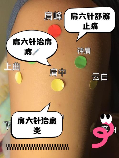 手臂酸痛可以针灸吗