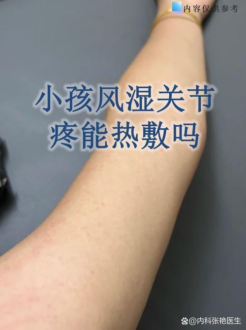 痛风肿了热敷还是冷敷