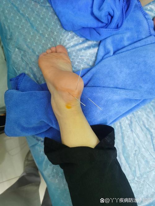 中医针灸治疗足跟痛