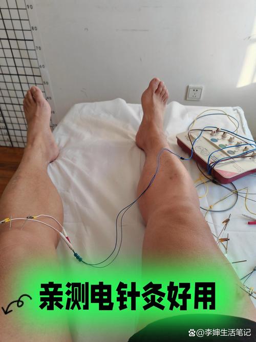 针灸适合肌肉拉伤吗