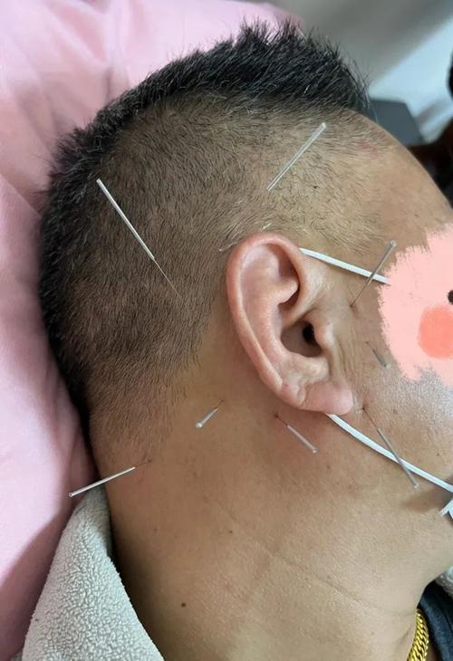 面神经麻木针灸治疗