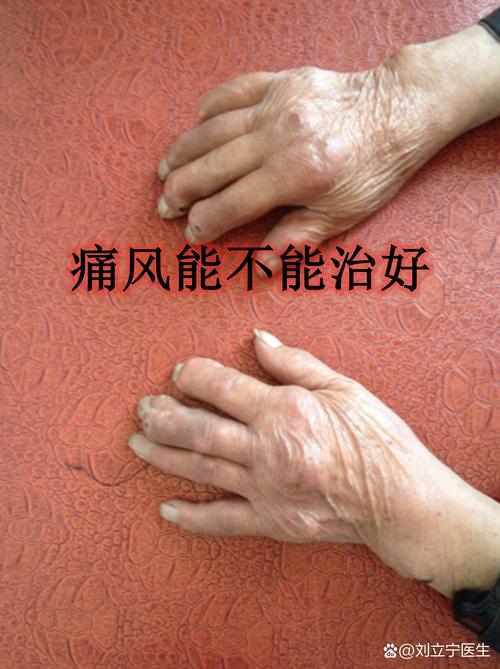 痛风全身结晶能活多久