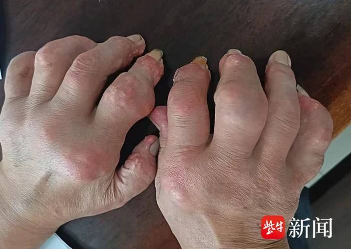 痛风全身结晶能活多久