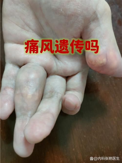 痛风会影响精子质量吗