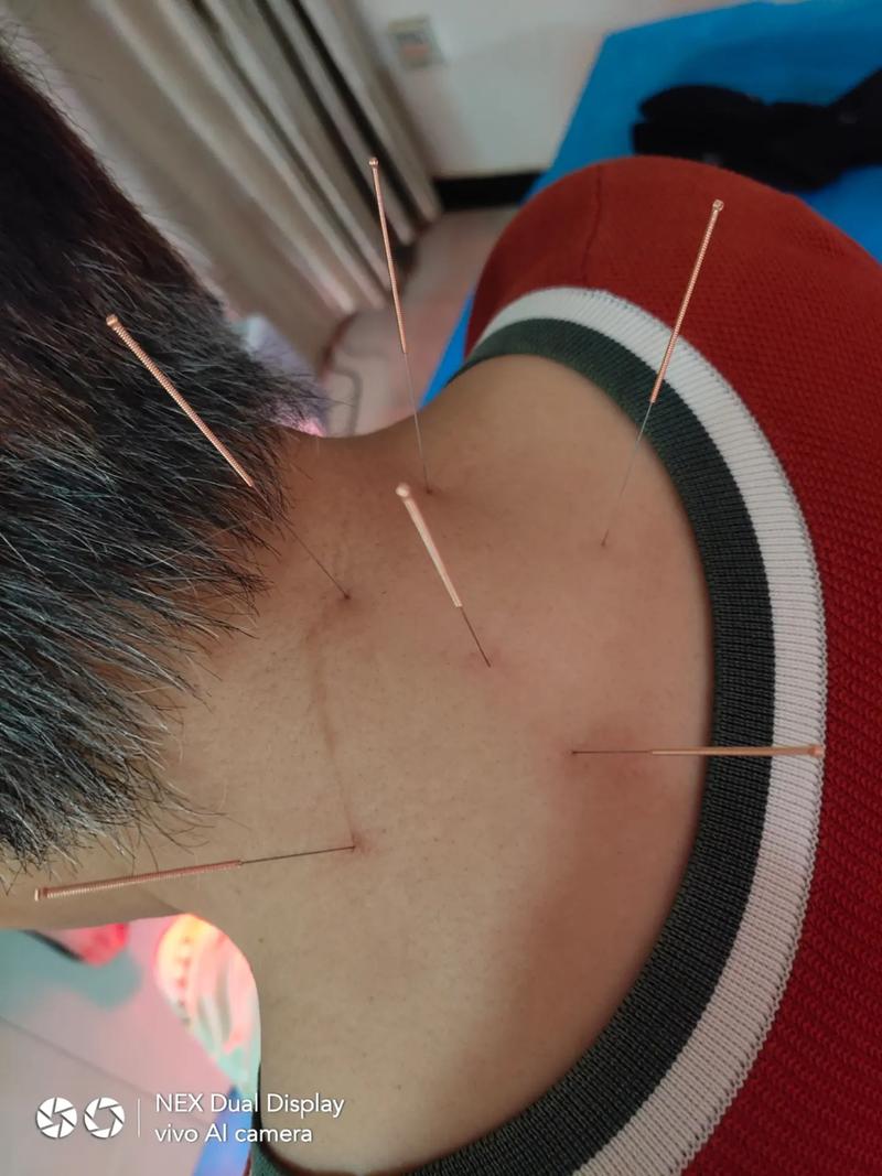 富贵包针灸效果怎样