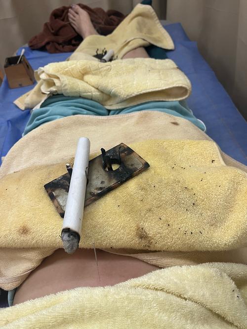 福州哪家医院有针灸