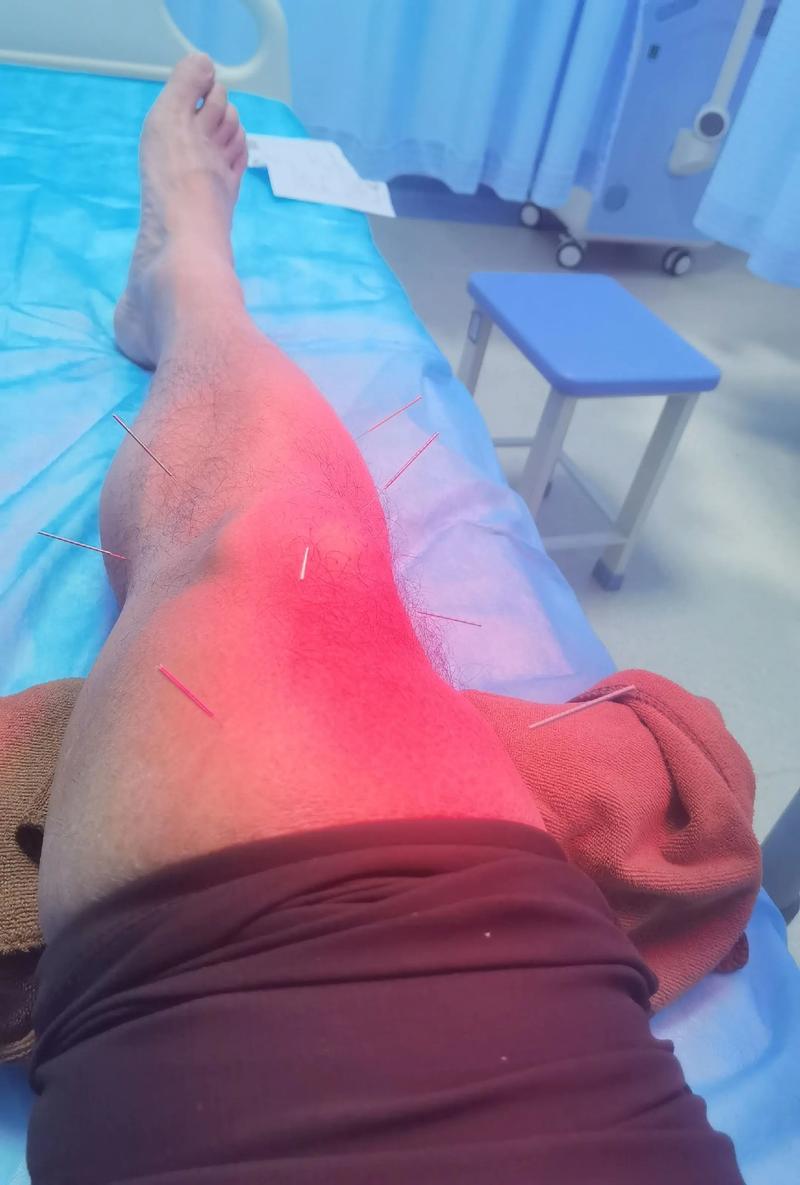 膝盖积水适合针灸吗