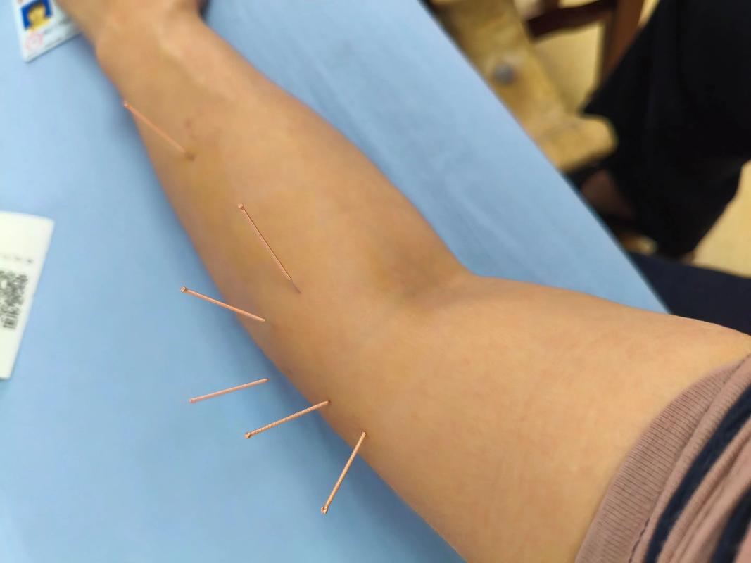 针灸可以治疗类风湿