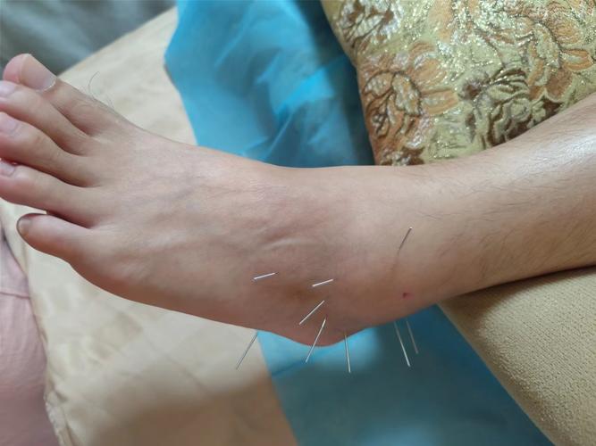 针灸可以治疗类风湿