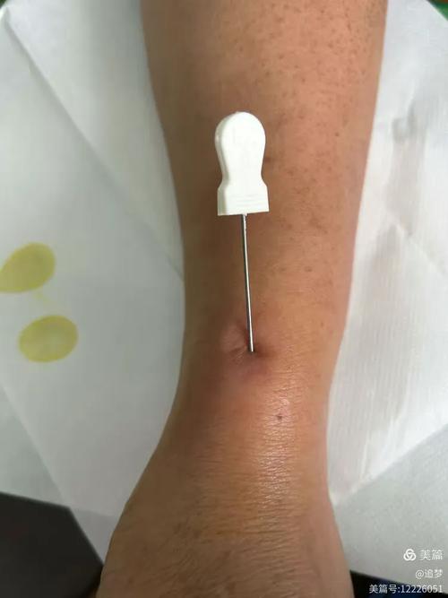 腱鞘囊肿的针灸治疗