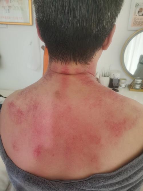 针灸导致气胸的症状