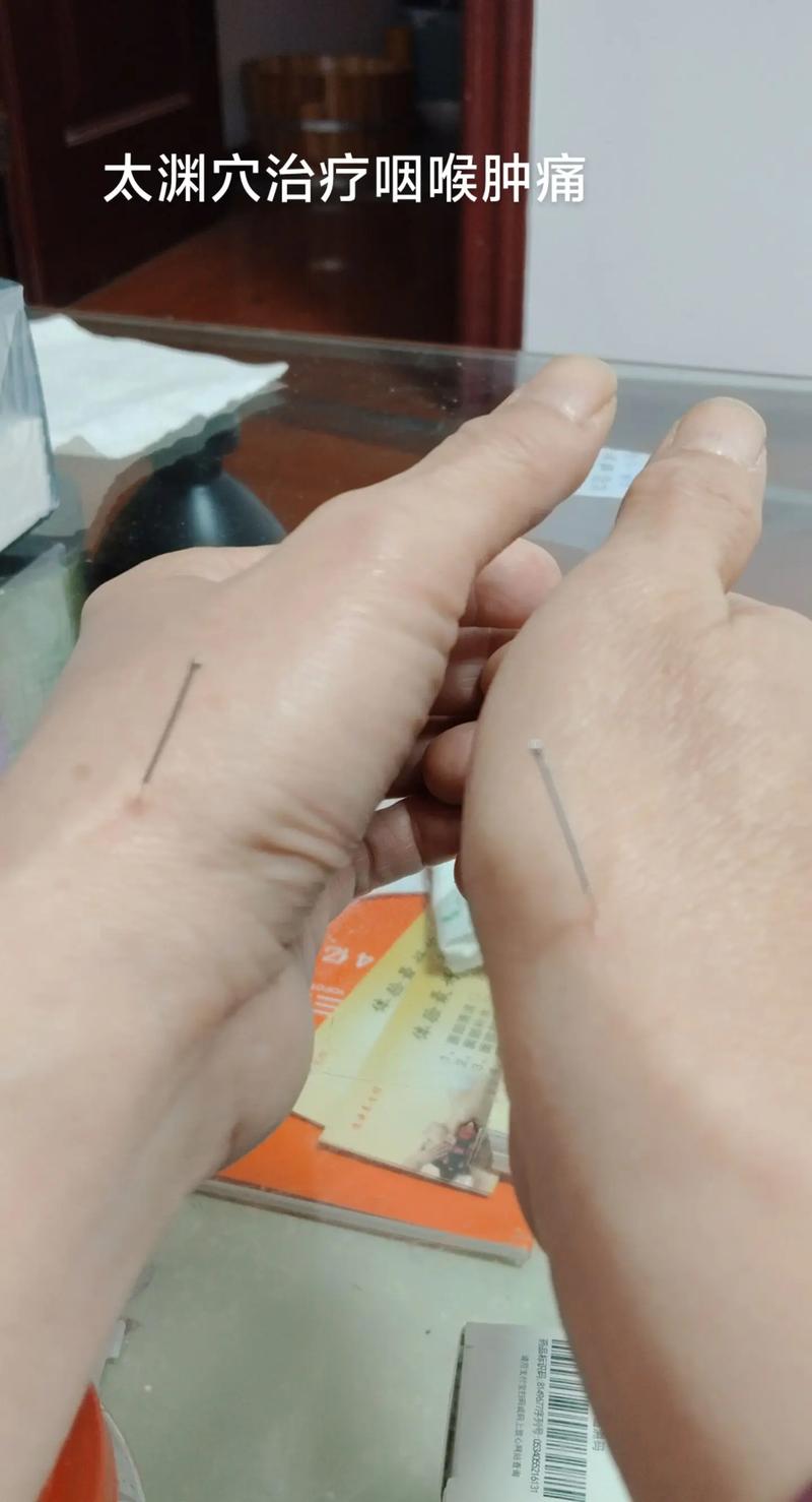 咽喉肿痛可以针灸吗