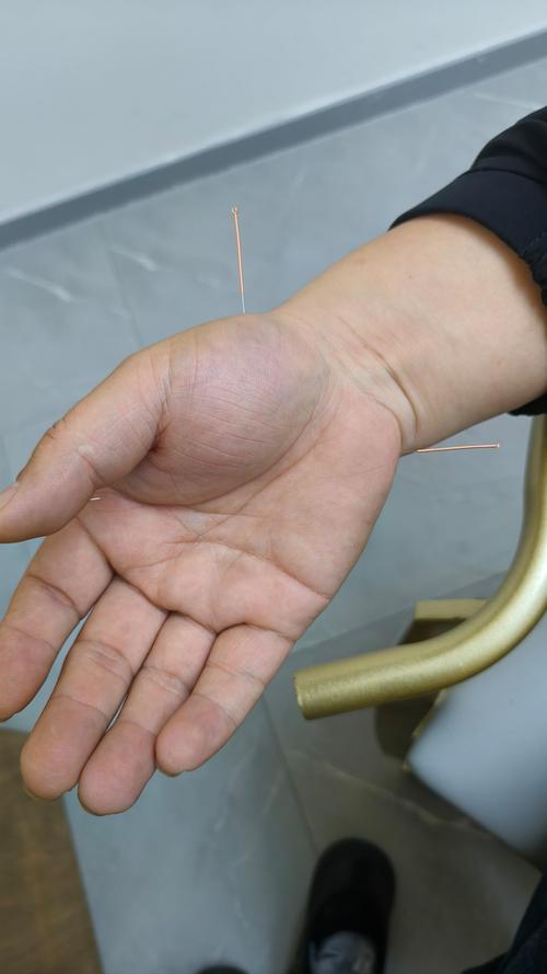 曙名中医养生 针灸