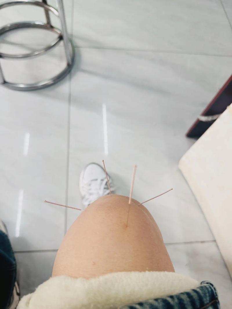 双下肢疼痛针灸治疗