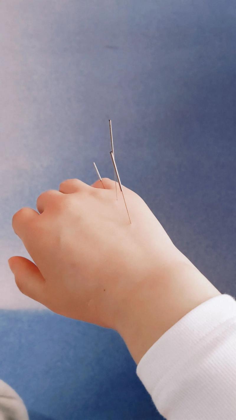 针灸效果是立刻突显