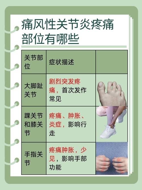 痛风去医院挂什么科室