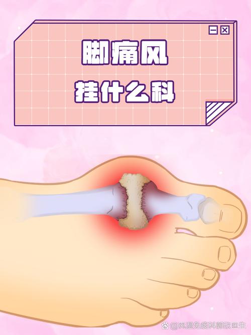 痛风去医院挂什么科室
