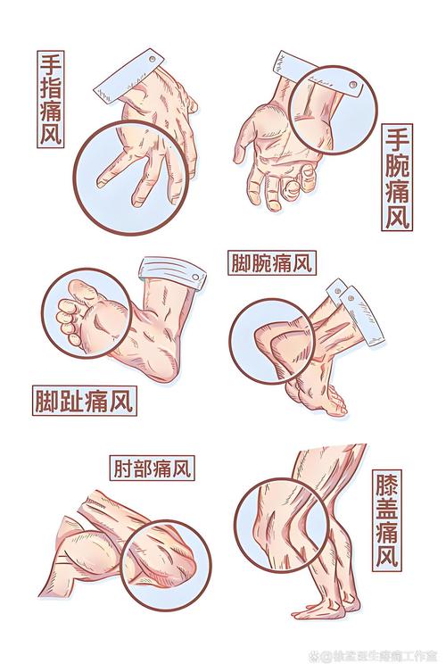 急性痛风发作怎么缓解