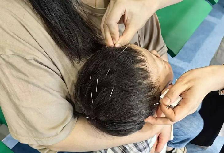 宝宝咳嗽可以针灸吗