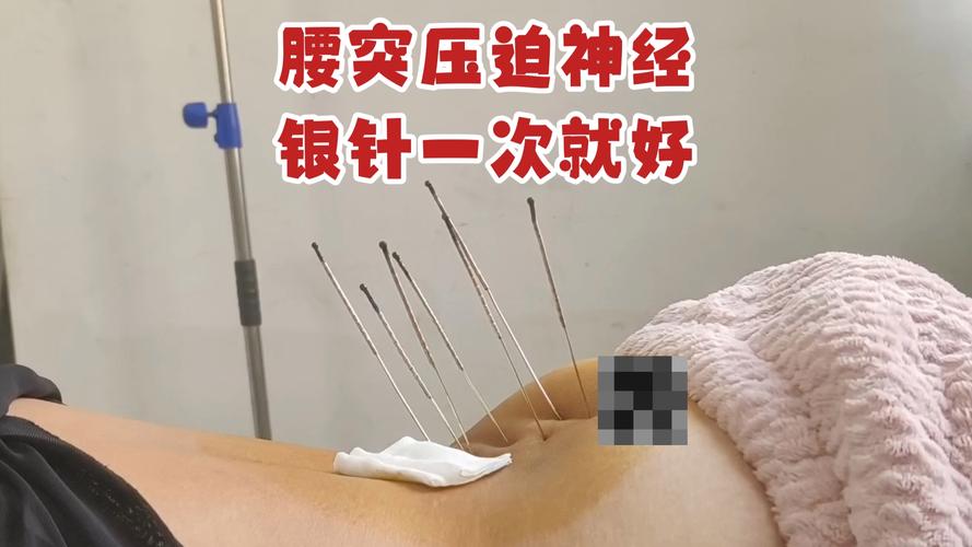 寒湿腰痛的针灸治疗