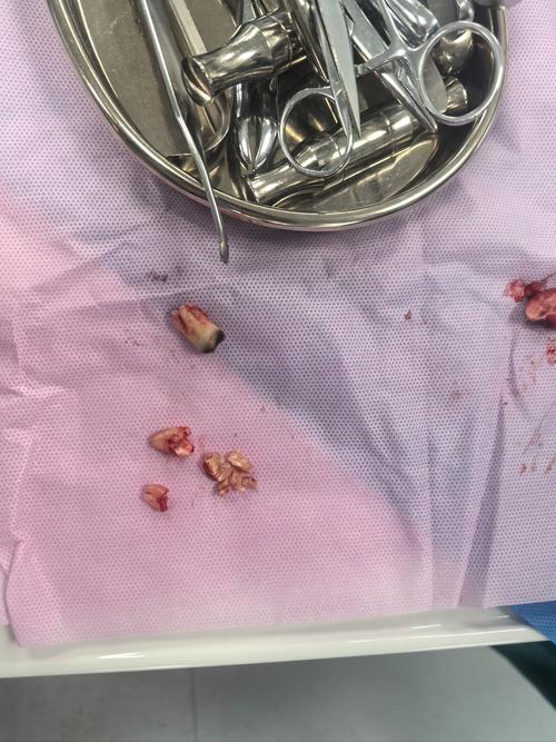 二甲医院拔智齿安全吗