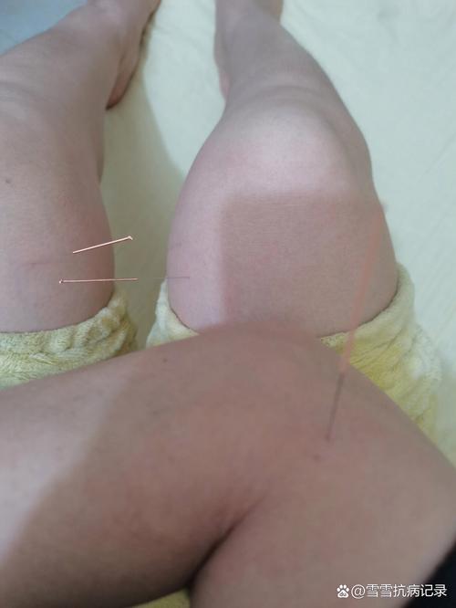 针灸过敏还能继续吗