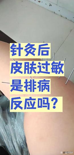 针灸过敏还能继续吗