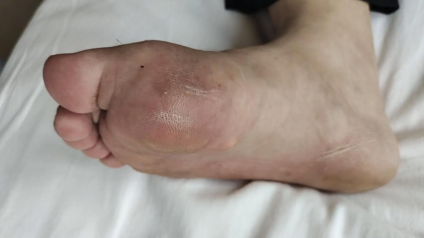 痛风在脚上的症状图片