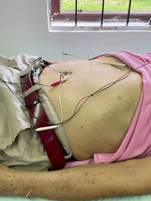 便秘可以针灸治疗吗