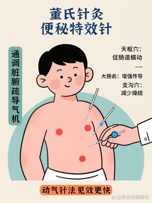 便秘可以针灸治疗吗