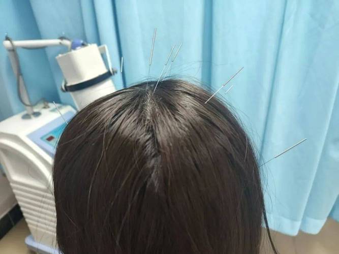 针灸完了晚上睡不着