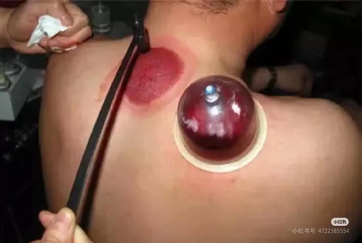 痛风刺络放血疗法视频