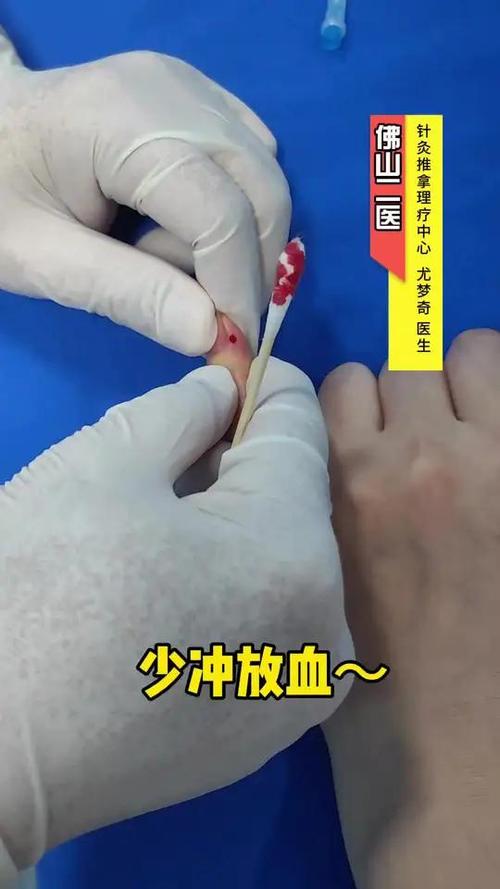 痛风刺络放血疗法视频