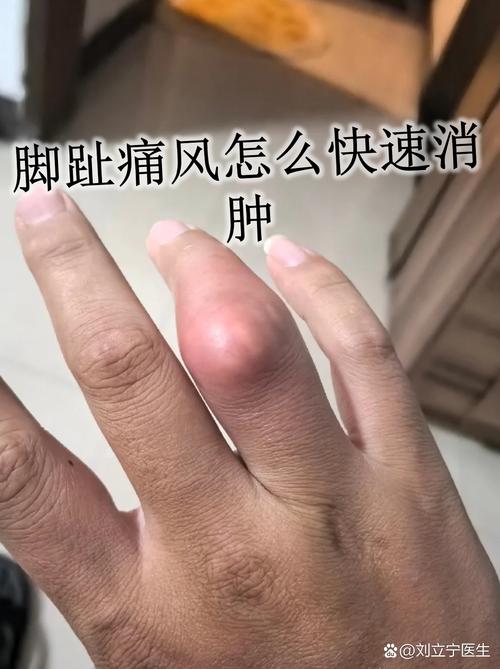 痛风复发快速消肿止痛