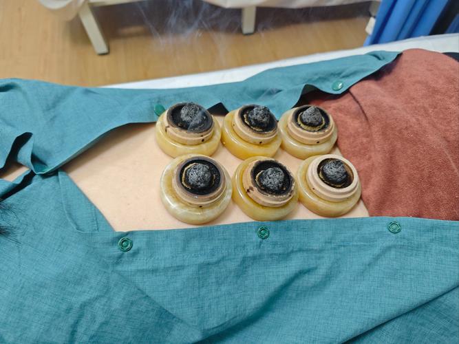 针灸治疗便秘得多久