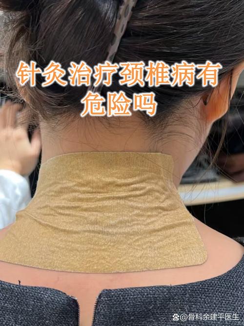 针灸治疗颈椎的故事