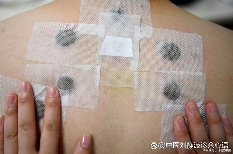 针灸贴贴上什么感觉