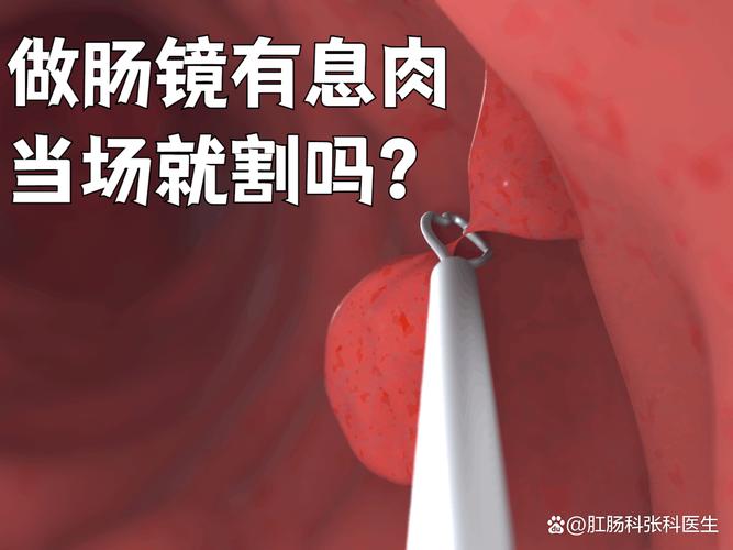 肠镜下切除息肉安全吗