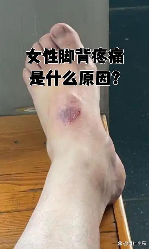 脚背痛 痛风快速去痛