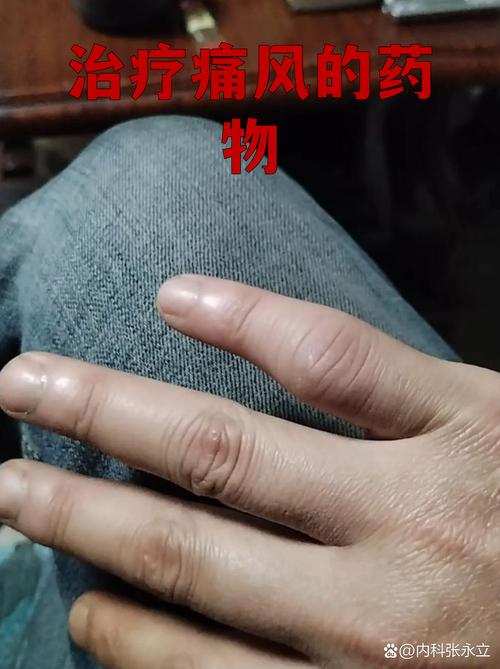 痛风药物对精子的影响