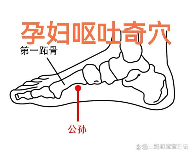 孕吐严重可以针灸吗