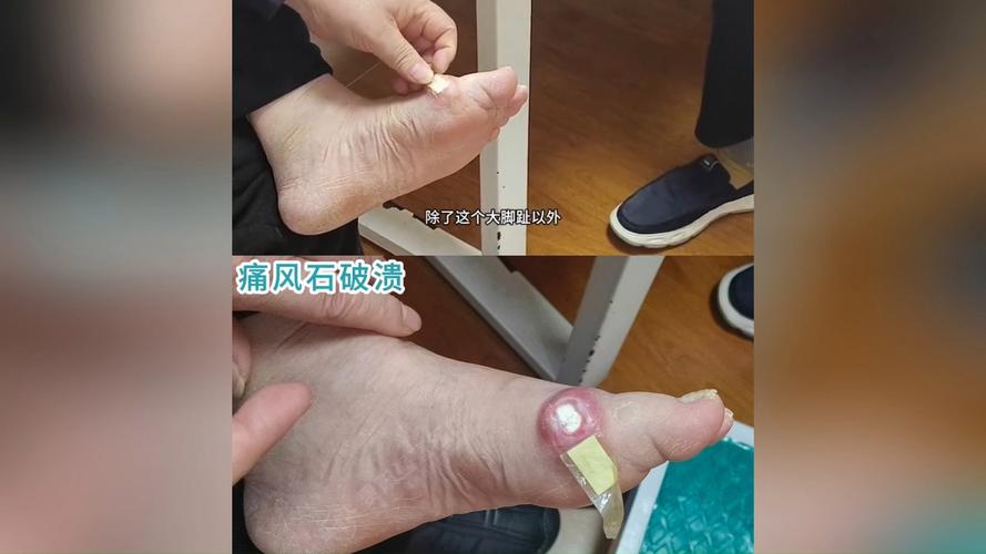 痛风最坏的结果会怎样