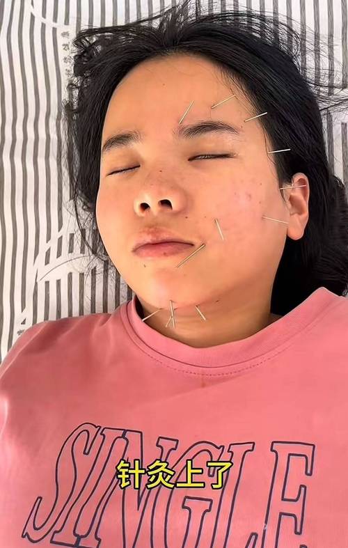 面瘫针灸后脸部跳动