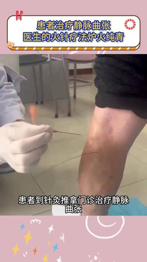 常州那里有针灸放血