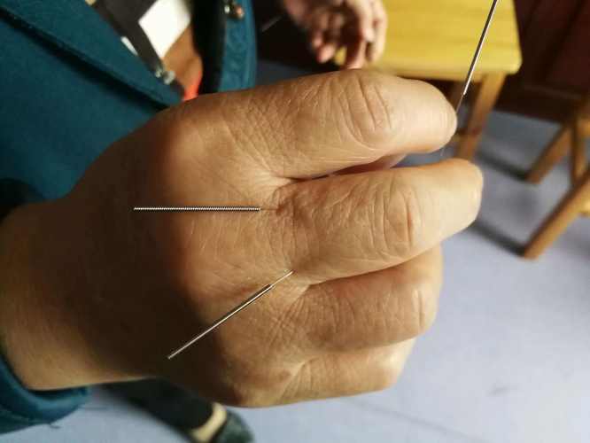 平衡针灸治疗脑萎缩