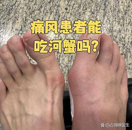 痛风患者可以吃河蟹吗