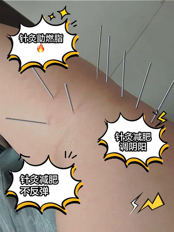 针灸减肥有哪些危害