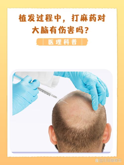 无痕植发海峡植发安全